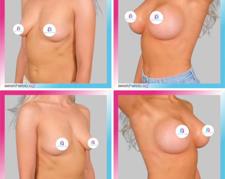 Brustvergrößerungen und Brustoperationen